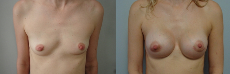 Anatomski implantati - 245 mL